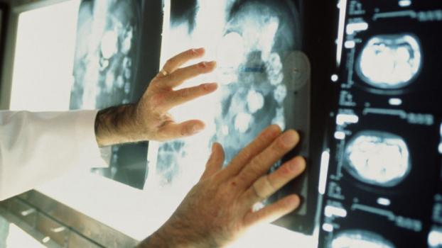 Такоцубо, или «синдром разбитого сердца», вызывает рак — ученые