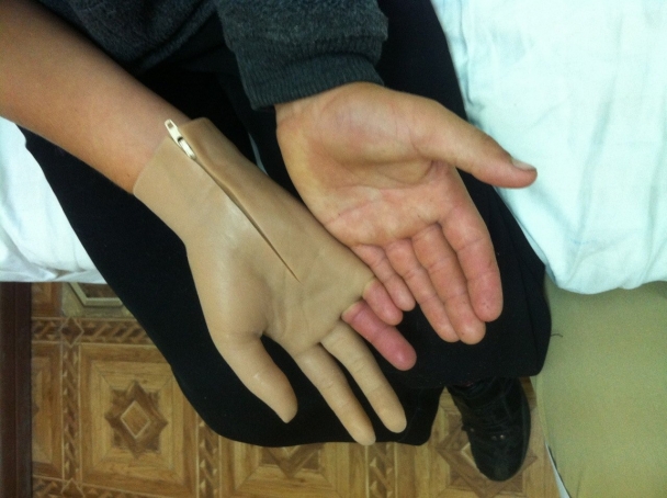 Потерявшему кисть от разрыва снаряда ребенку из Донецкой области в Киеве установили протез
