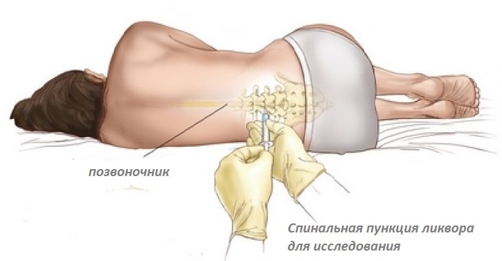 В Украине зафиксировали 162 случая менингококковой инфекции с начала года