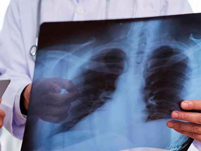 В Константиновке зафиксировано 120 случаев заболеваний пневмонией с начала года