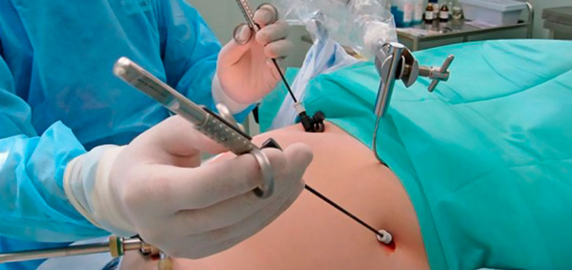 удаление кисты удаление кисты