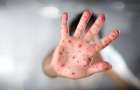 23 people fell ill with measles over the week in Mariupol