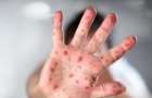 Measles in Ukraine: a child died with contraindications to vaccination