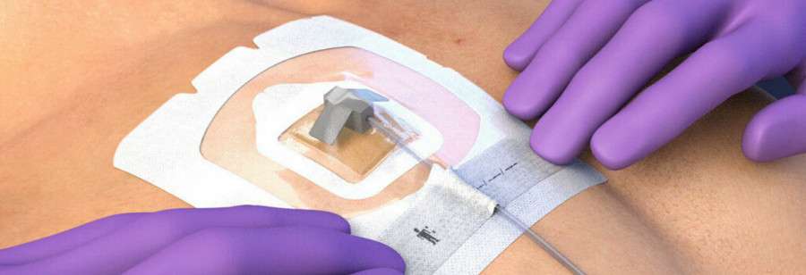 Внутривенный порт при химиотерапии: комфорт и безопасность во время лечения