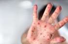 6 children fell ill with measles for a week in Mariupol